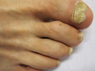 mycoses des pieds sous les ongles